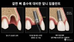 앞니 임플란트, 잇몸 형태 고려한 치료 계획 필요
