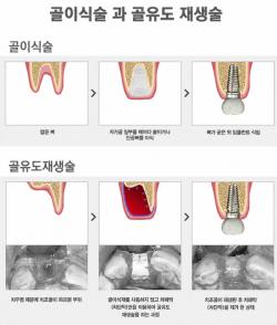 잇몸뼈 부족한 임플란트, 재건 가능할까