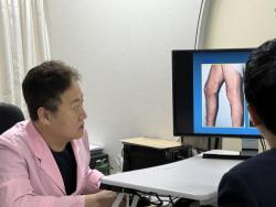 여름철 하지정맥류, 초기 진단 중요